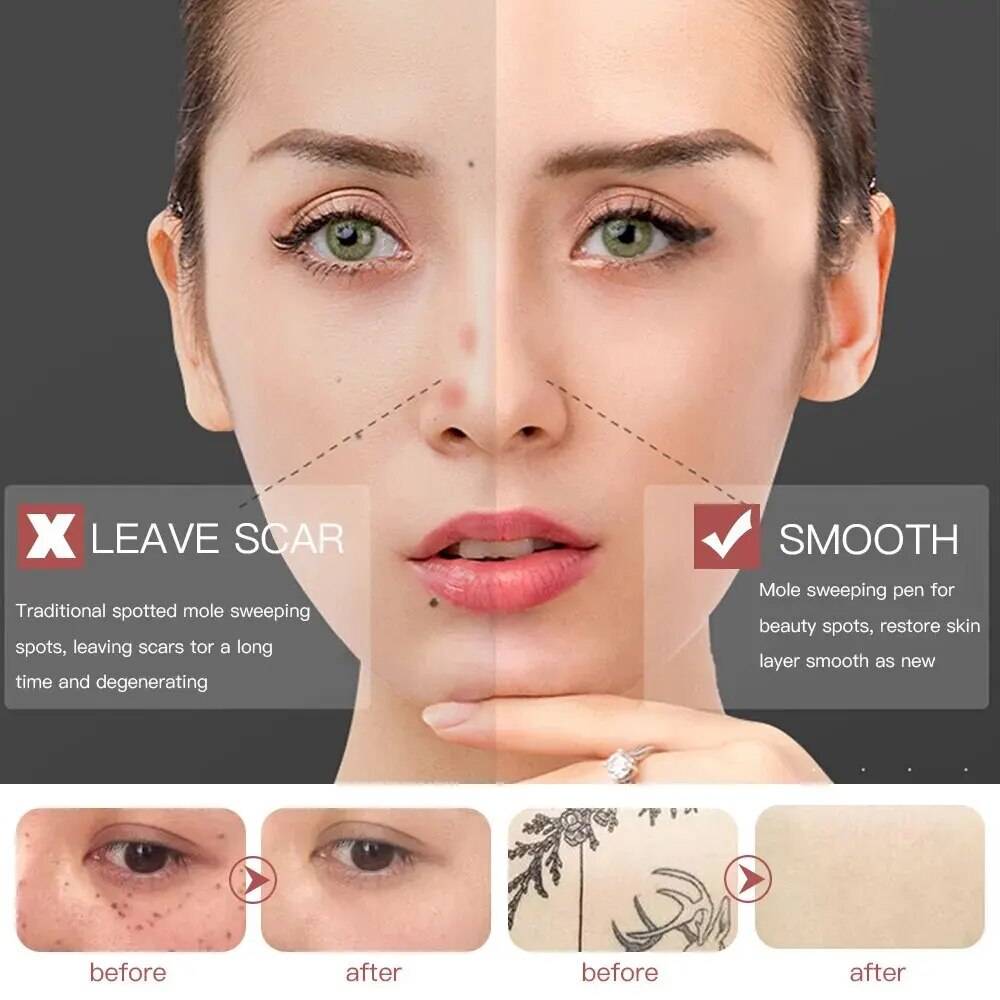 Smart mole remover pen