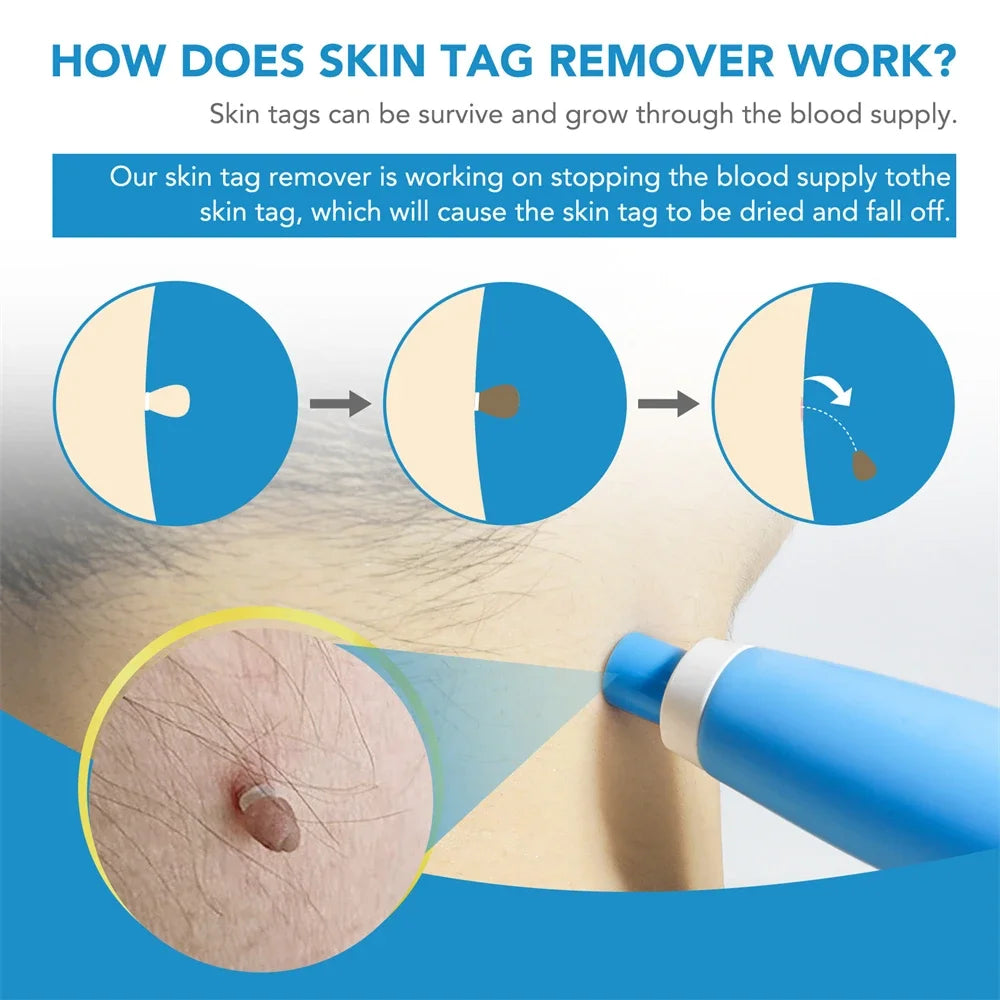 Pimple Remover tool