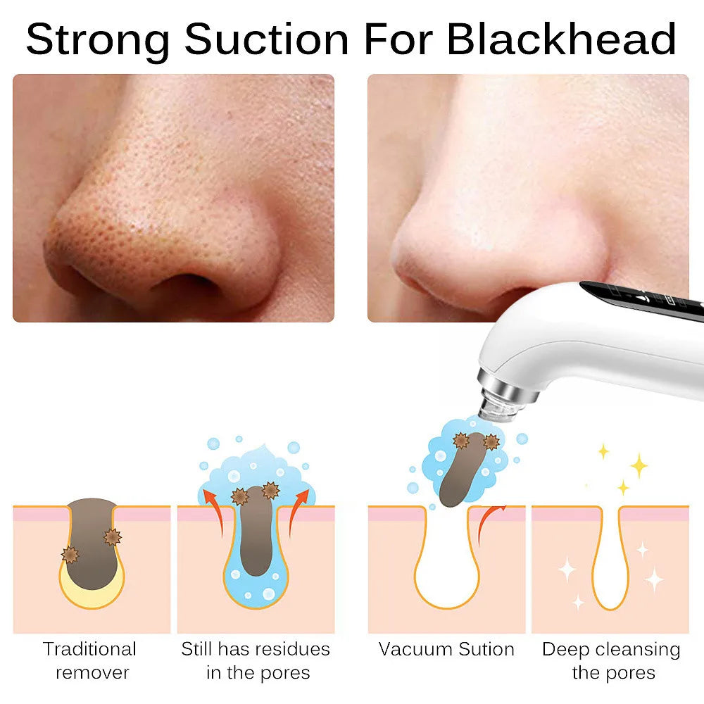 Blackhead remover vacuum device