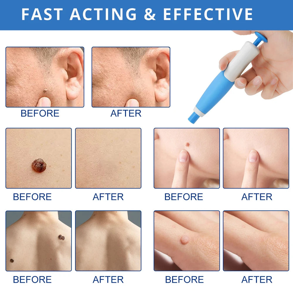 Pimple Remover tool