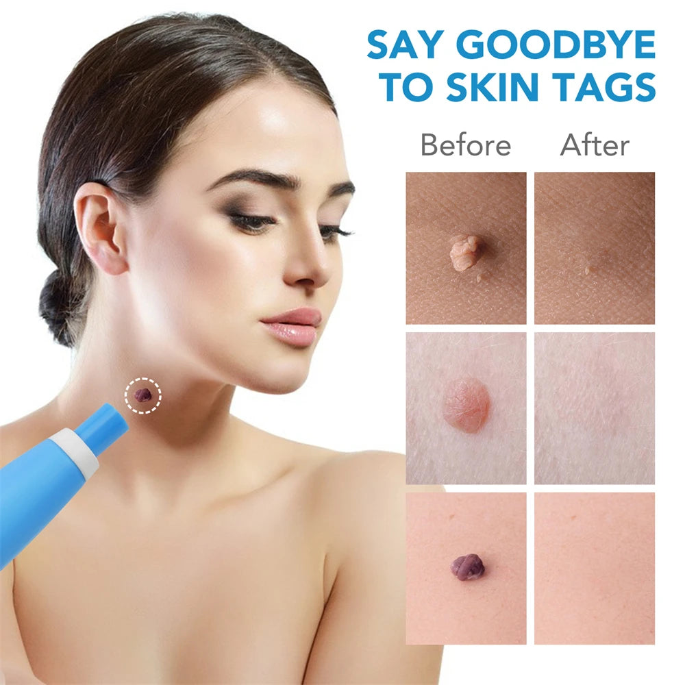 Pimple Remover tool