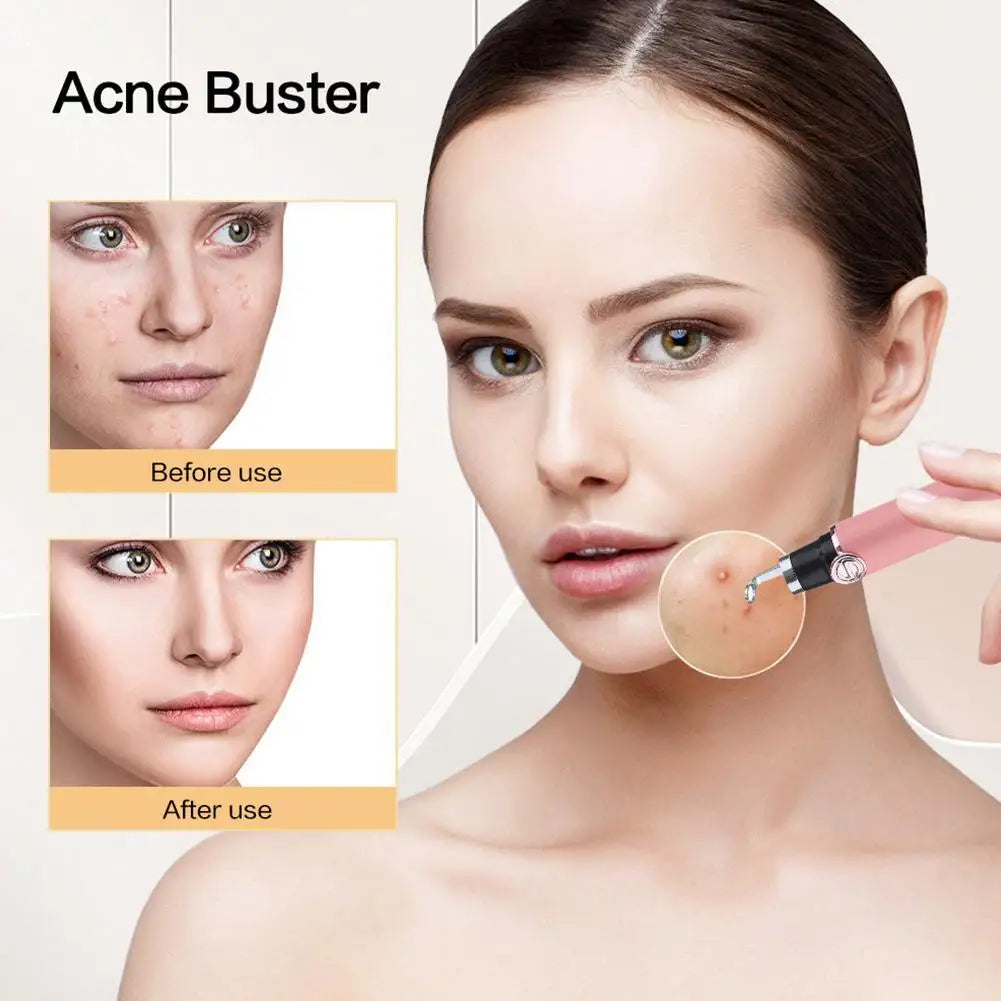 Smart visual pimple popper with camera