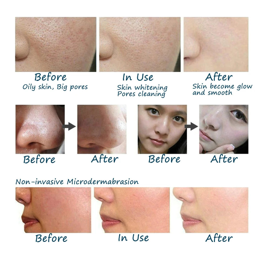 Handheld smart microdermabrasion