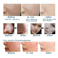 Handheld smart microdermabrasion